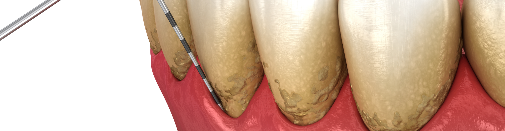 dental scraper removing buildup from front of teeth.